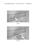 SUTURE PASSER DEVICES AND METHODS diagram and image