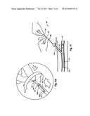 COMPRESSIBLE ARTERIOTOMY LOCATOR FOR VASCULAR CLOSURE DEVICES AND METHODS diagram and image