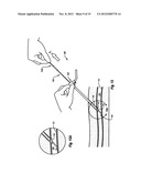 COMPRESSIBLE ARTERIOTOMY LOCATOR FOR VASCULAR CLOSURE DEVICES AND METHODS diagram and image