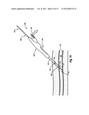 COMPRESSIBLE ARTERIOTOMY LOCATOR FOR VASCULAR CLOSURE DEVICES AND METHODS diagram and image