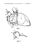 BARRIER DEVICE FOR OSTIUM OF LEFT ATRIAL APPENDAGE diagram and image