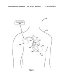 SELECTIVELY ENABLING A PASSIVE RECHARGE CYCLE FOR AN IMPLANTABLE CARDIAC     STIMULATION DEVICE diagram and image