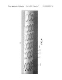 HELICAL HYBRID STENT diagram and image