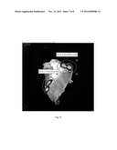 SDF-1 Delivery For Treating Ischemic Tissue diagram and image