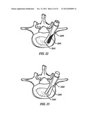 Anti-Rotation Fixation Element for Spinal Prostheses diagram and image