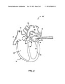 BATTERY FEEDTHROUGH FOR AN IMPLANTABLE MEDICAL DEVICE diagram and image