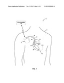 AV NODAL STIMULATION DURING ATRIAL TACHYARRHYTHMIA TO PREVENT     INAPPROPRIATE THERAPY DELIVERY diagram and image