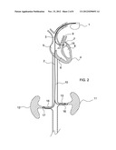 RENAL NERVE STIMULATION LEAD, DELIVERY SYSTEM, AND METHOD diagram and image