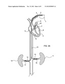 RENAL NERVE STIMULATION LEAD, DELIVERY SYSTEM, AND METHOD diagram and image