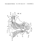 DRUG RETAINING SURFACE FEATURES IN AN IMPLANTABLE MEDICAL DEVICE diagram and image