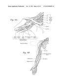 SYSTEMS AND METHODS TO PLACE ONE OR MORE LEADS IN TISSUE TO ELECTRICALLY     STIMULATE NERVES TO TREAT PAIN diagram and image