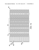 INTRA-ATRIAL IMPLANTS MADE OF NON-BRAIDED MATERIAL diagram and image