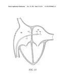 INTRA-ATRIAL IMPLANTS MADE OF NON-BRAIDED MATERIAL diagram and image