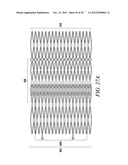 INTRA-ATRIAL IMPLANTS MADE OF NON-BRAIDED MATERIAL diagram and image