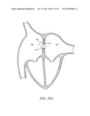 INTRA-ATRIAL IMPLANTS MADE OF NON-BRAIDED MATERIAL diagram and image