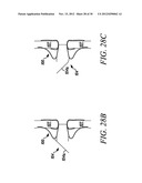 INTRA-ATRIAL IMPLANTS MADE OF NON-BRAIDED MATERIAL diagram and image