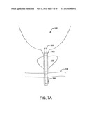 Pre-Positioned Anastomosis Device and Related Methods of Use diagram and image