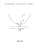 Pre-Positioned Anastomosis Device and Related Methods of Use diagram and image