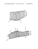 VASCULAR REMODELING DEVICE diagram and image