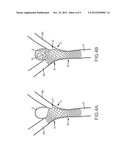 VASCULAR REMODELING DEVICE diagram and image