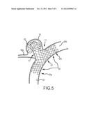 VASCULAR REMODELING DEVICE diagram and image