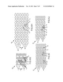 VASCULAR REMODELING DEVICE diagram and image