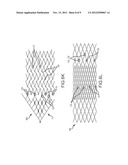 VASCULAR REMODELING DEVICE diagram and image