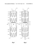 PARAPLEGIA PREVENTION VALVE FOR STENT GRAFTS diagram and image