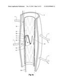 PARAPLEGIA PREVENTION VALVE FOR STENT GRAFTS diagram and image