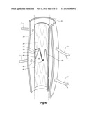 PARAPLEGIA PREVENTION VALVE FOR STENT GRAFTS diagram and image