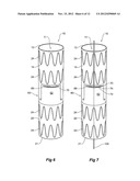 PARAPLEGIA PREVENTION VALVE FOR STENT GRAFTS diagram and image