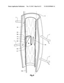 PARAPLEGIA PREVENTION VALVE FOR STENT GRAFTS diagram and image