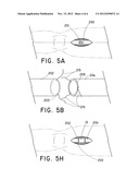 EMERGENCY VASCULAR REPAIR PROSTHESIS diagram and image