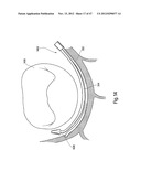 TISSUE RESTRAINING DEVICES AND METHODS OF USE diagram and image