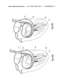 TISSUE RESTRAINING DEVICES AND METHODS OF USE diagram and image