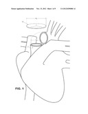 PROSTHETIC TISSUE VALVE diagram and image