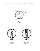 INTRAOCULAR CAPSULAR TENSION RINGS diagram and image