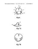 INTRAOCULAR CAPSULAR TENSION RINGS diagram and image