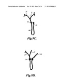 INTRAOCULAR CAPSULAR TENSION RINGS diagram and image