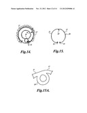 INTRAOCULAR CAPSULAR TENSION RINGS diagram and image