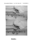 MINIMALLY INVASIVE SURGICAL TOOLS FOR HIP PROSTHESIS diagram and image