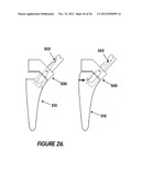 MINIMALLY INVASIVE SURGICAL TOOLS FOR HIP PROSTHESIS diagram and image