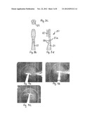 RESONANT VIBRATION-ENHANCING CLEANING ATTACHMENT FOR AN ULTRASONIC POWERED     HANDLE diagram and image