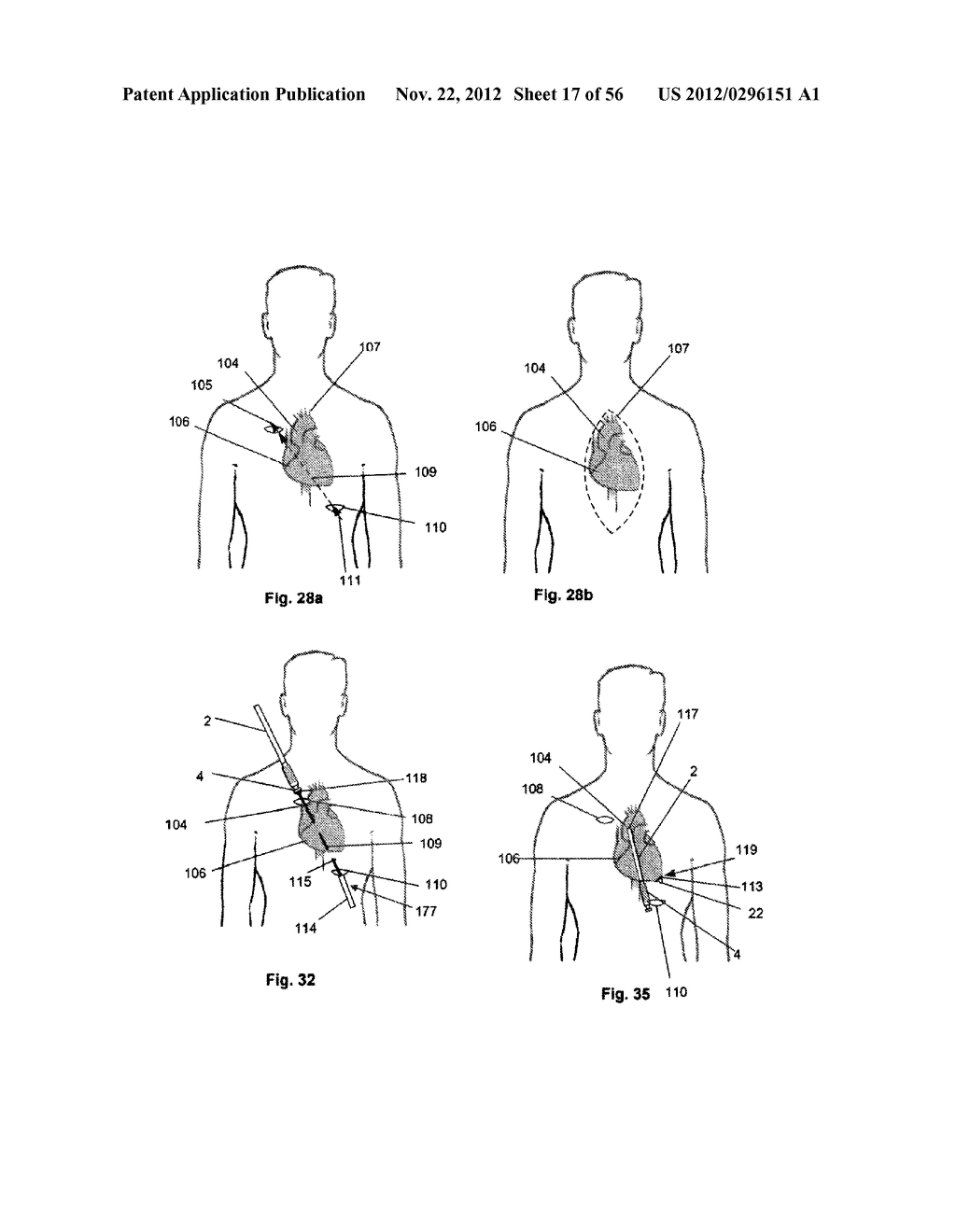 ASSEMBLY AND METHOD OF IMPLANTING A HEART ASSIST SYSTEM - diagram, schematic, and image 18