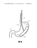 METHODS AND DEVICES FOR INTRAGASTRIC SUPPORT OF FUNCTIONAL OR PROSTHETIC     GASTROINTESTINAL DEVICES diagram and image