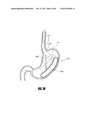 METHODS AND DEVICES FOR INTRAGASTRIC SUPPORT OF FUNCTIONAL OR PROSTHETIC     GASTROINTESTINAL DEVICES diagram and image