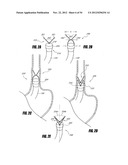 METHODS AND DEVICES FOR INTRAGASTRIC SUPPORT OF FUNCTIONAL OR PROSTHETIC     GASTROINTESTINAL DEVICES diagram and image