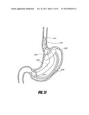 METHODS AND DEVICES FOR INTRAGASTRIC SUPPORT OF FUNCTIONAL OR PROSTHETIC     GASTROINTESTINAL DEVICES diagram and image