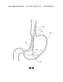 METHODS AND DEVICES FOR INTRAGASTRIC SUPPORT OF FUNCTIONAL OR PROSTHETIC     GASTROINTESTINAL DEVICES diagram and image