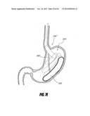 METHODS AND DEVICES FOR INTRAGASTRIC SUPPORT OF FUNCTIONAL OR PROSTHETIC     GASTROINTESTINAL DEVICES diagram and image